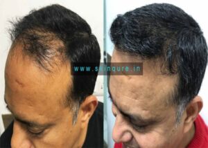 Best-Hair-Transplant-Clinic-in-Delhi