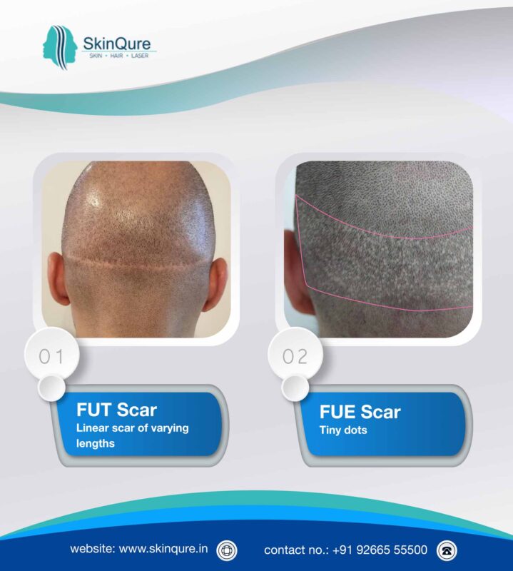 types of hair transplant scar