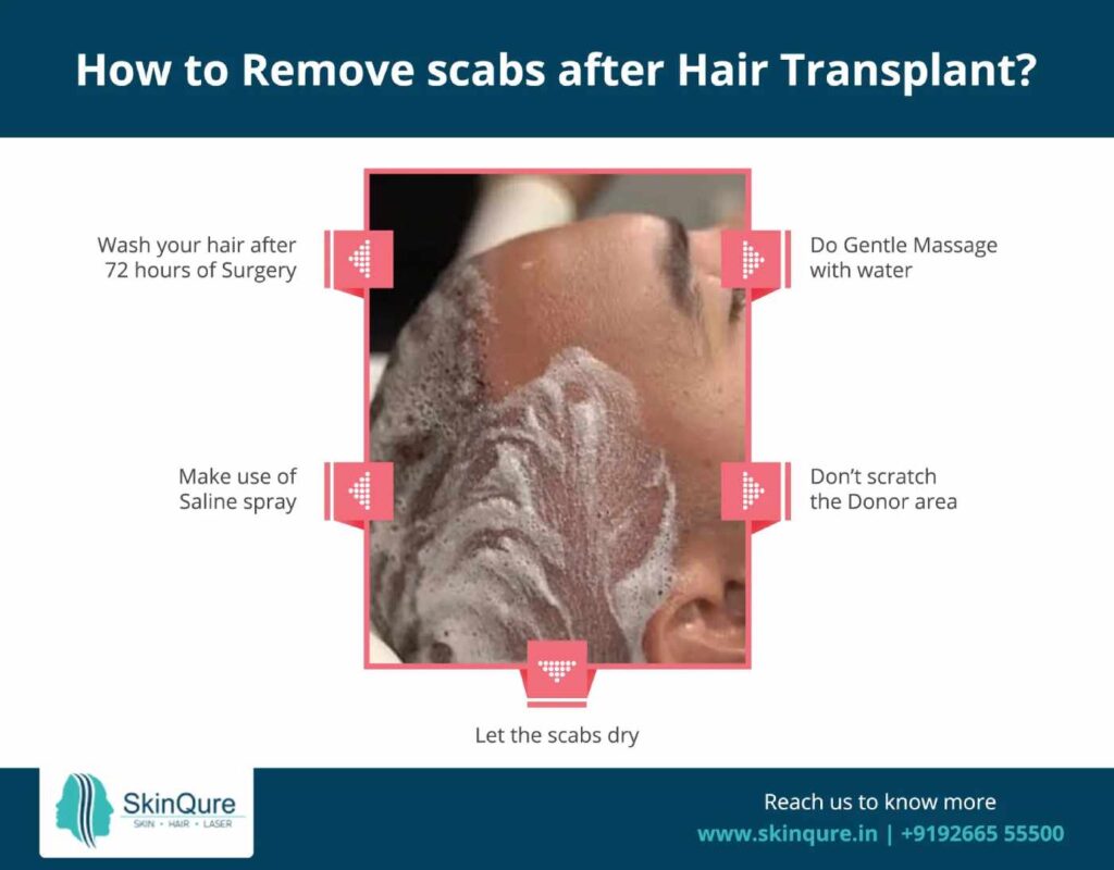 How to remove scabs after hair transplant