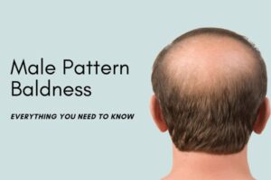 Male Pattern Baldness