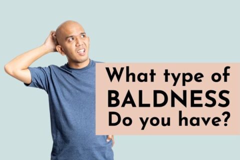 What type of baldness do you have?
