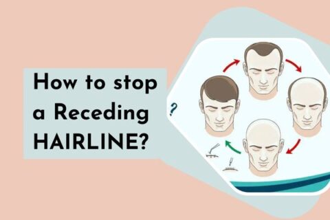 how to stop a receding hairline