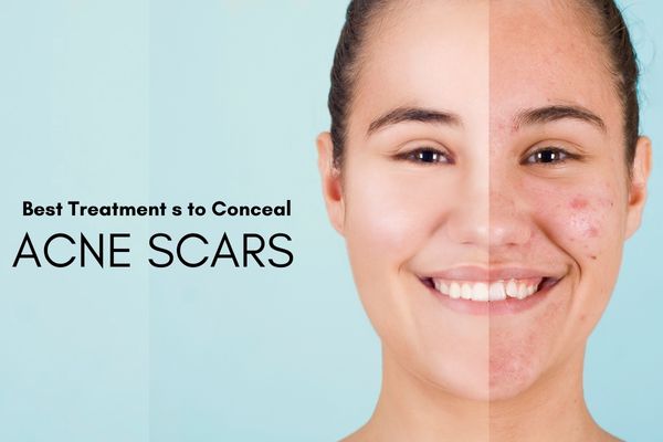 Best Treatments to Conceal Acne Scars - SkinQure