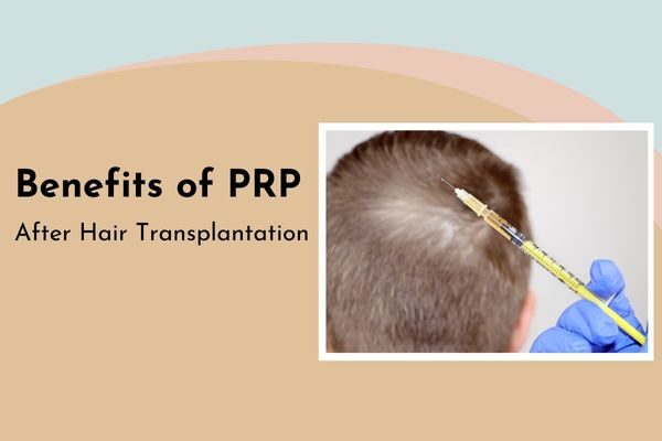 Benefits of PRP after hair transplantation