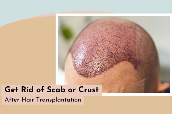 Get rid of scabs or crust after hair transplant