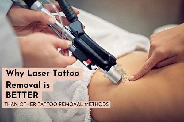 Why Laser Tattoo Removal is Better than its alternative methods - SkinQure
