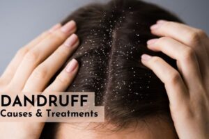 dandruff treatment