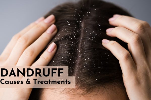 What is dandruff? Its cause, symptoms and treatment options - SkinQure