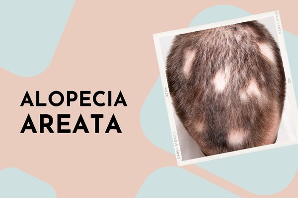 Alopecia Areata