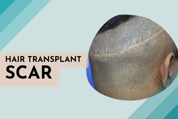 hair transplant scar