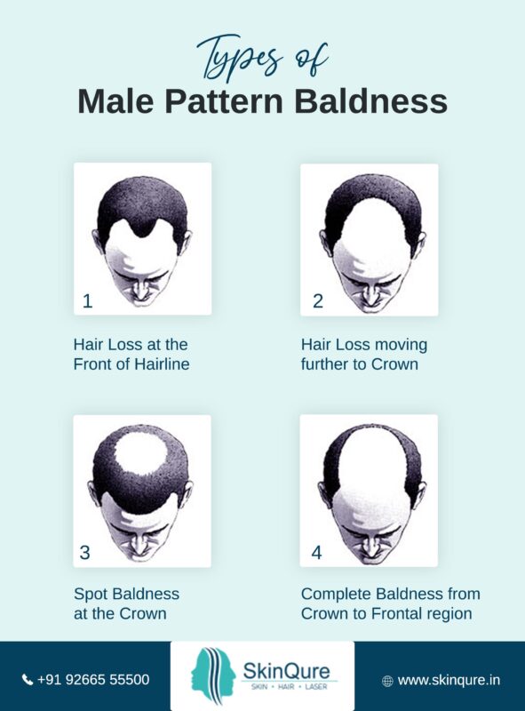 Types of male pattern baldness