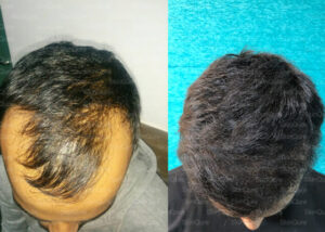 bEFORE-AFTER
