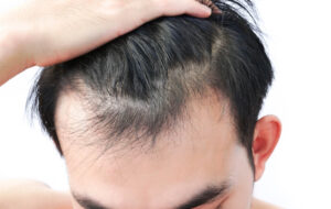 Hair Transplant SkinQure