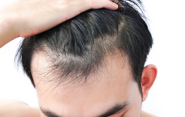 Hair Transplant SkinQure
