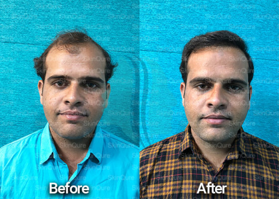 hair-transplant