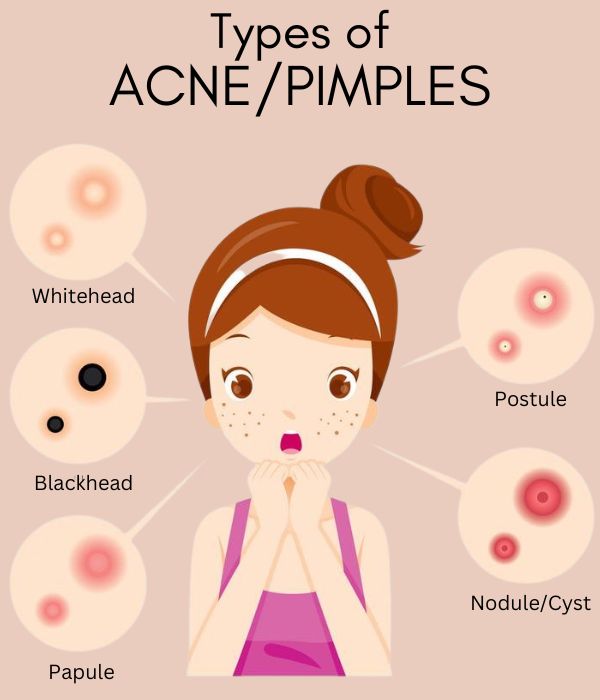 common types of acne