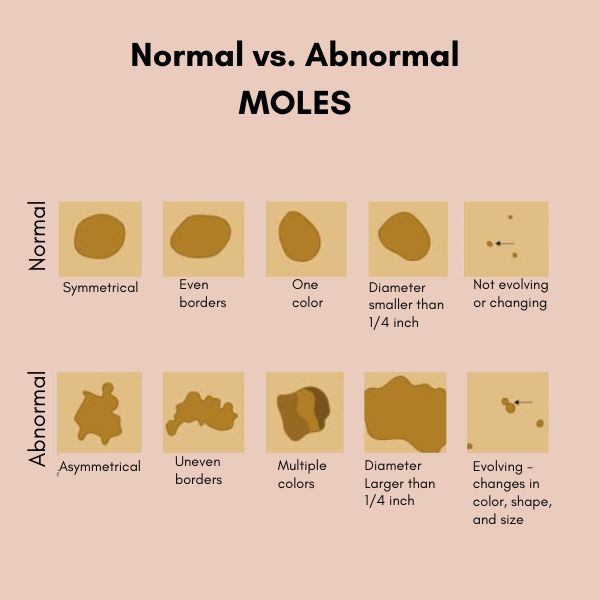 Normal vs abnormal moles