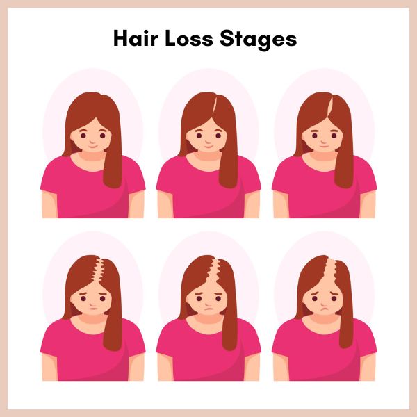 hair loss stages in female