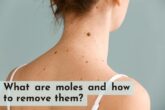 what are mole and how to remove them?