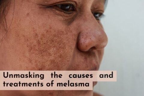 unmasking the causes and treatments of melasma