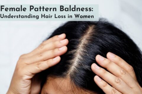 female pattern baldness in south delhi