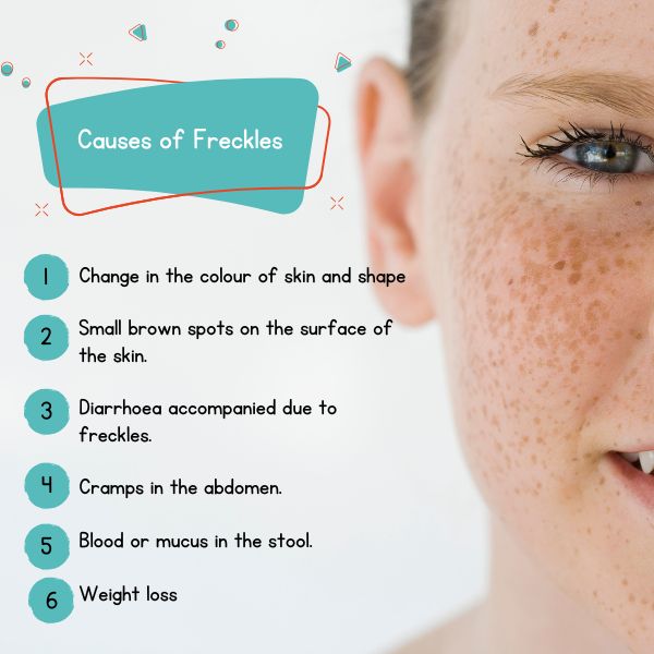 causes and symptoms of freckles