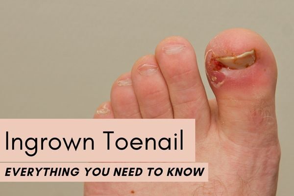 ingrown toenail removal in saket