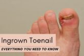 ingrown toenail removal in saket