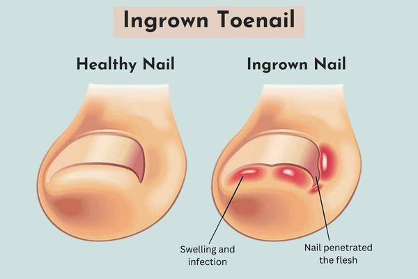 ingrown toenail