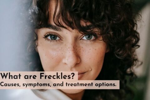 freckles treatment in south delhi