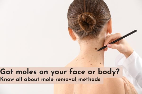 Got moles on your face or body? Know all about mole removal methods ...