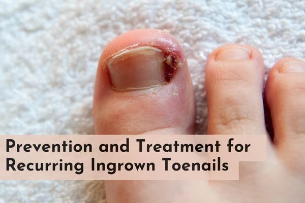 Ingrown Nails: Causes, Prevention, and Treatment