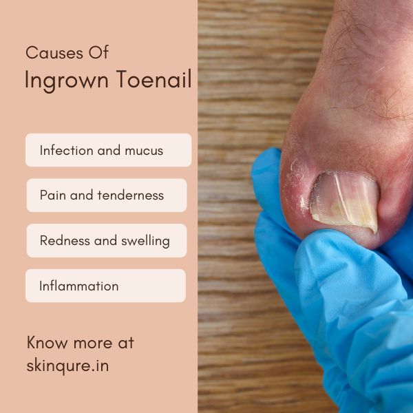 causes of ingrown toenail