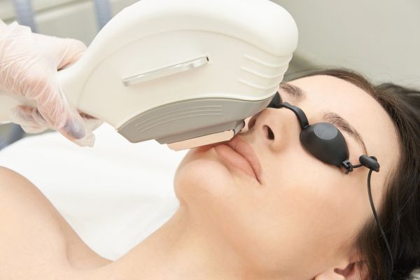 IPL laser treatment