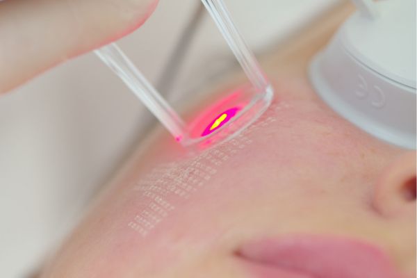 laser skin resurfacing