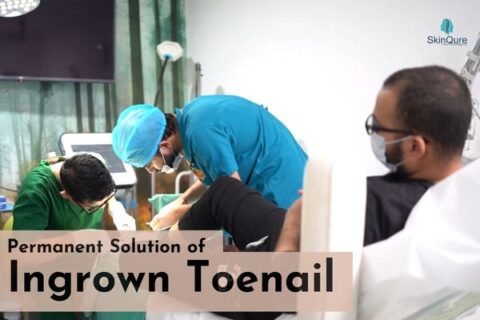permanent solution of ingrown toenail