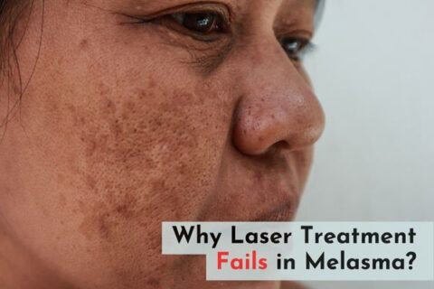 why laser treatment fails in Melasma?