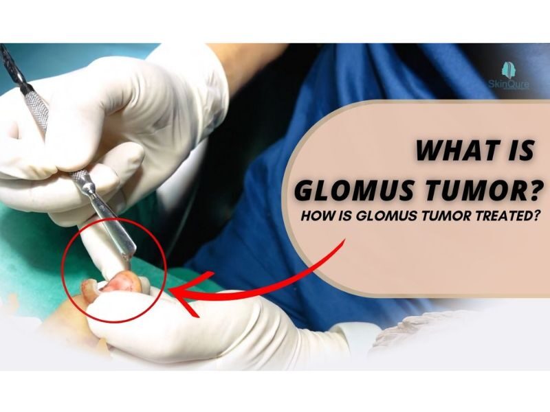 What is Glomus Tumor?