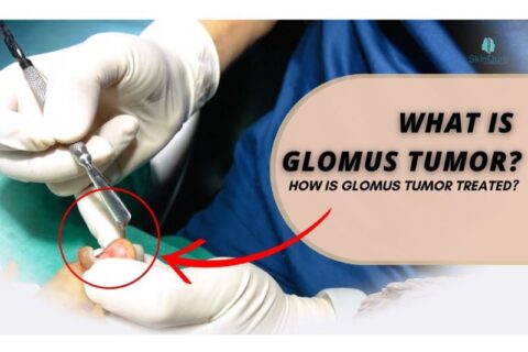 What is Glomus Tumor?