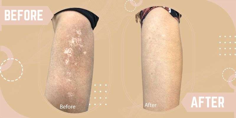 Vitiligo treatment in Delhi