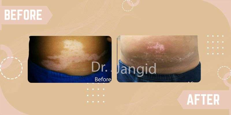 Vitiligo treatment in Delhi