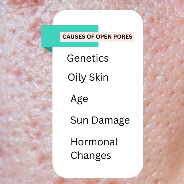 Open pores causes