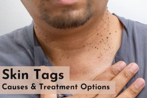 skin tags treatment in Saket