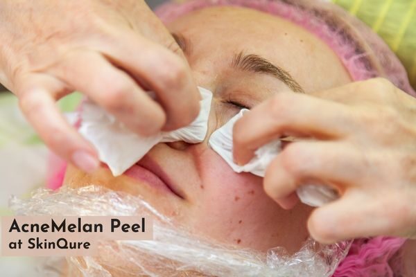 AcneMelan Peel in delhi