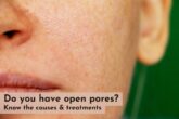 Open Pores