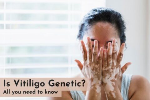 Is vitiligo genetic?
