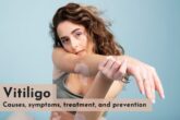 vitiligo treatment in delhi