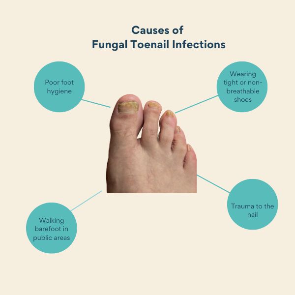 toenail fungal infection