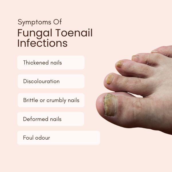 toenail fungal infection treatment