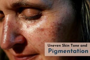 uneven skin tone and pigmentation